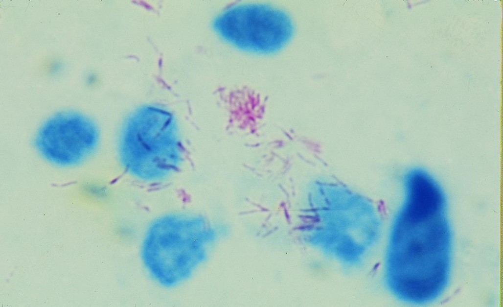 麻风分枝杆菌抗酸染色图片
